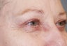 Eyelid surgery