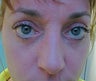 Eyelid Surgery