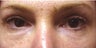 Upper Blepharoplasty 