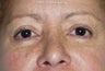 Eyelid Surgery