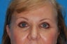 Upper blepharoplasty, lower blepharoplasty, and revision rhinoplasty