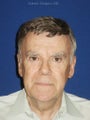 Upper and Lower Blepharoplasty