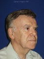 Upper and Lower Blepharoplasty