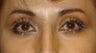 Upper Lid ptosis repair