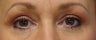 Upper Blepharoplasty