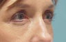 Lower blepharoplasty with fat repositioning