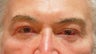 Lower blepharoplasty with fat repositioning