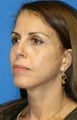 eye rejuvenation