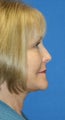 eye rejuvenation