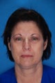 Blepharoplasty