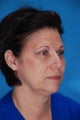 Blepharoplasty