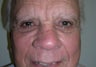 Blepharoplasty
