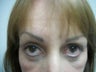 Blepharoplasty