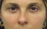 Lower eyelid blepharoplasty with cheek lift 
