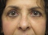 Upper and lower bleph and cheek lift