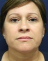 Eyelid Surgery