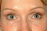 Eyelid Surgery