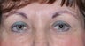 Eyelid Surgery