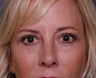 Upper and Lower Eyelids