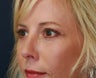 Upper and Lower Eyelids
