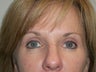 Blepharoplasty