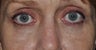 Eyelid Surgery