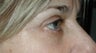 Eyelid Surgery