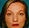 Blepharoplasty (Upper and Lower eyelids)