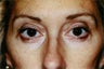 Blepharoplasty (lower eyelid surgery)