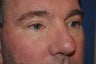 Blepharoplasty (lower eyelid surgery)
