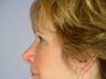 Eyelid Surgery