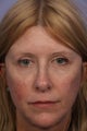 Eyelid Surgery