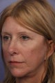 Eyelid Surgery