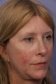 Eyelid Surgery