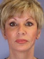 Eyelid Surgery