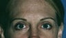 Upper and lower eyelid (blepharoplasty) Surgery