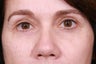 Blepharoplasty / Eyelid Surgery