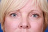 Blepharoplasty / Eyelid Surgery