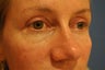 Blepharoplasty (Upper eyelids)