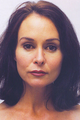 Brow Lift