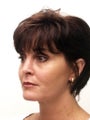 Eyelid Surgery