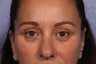 Eyelid Surgery 