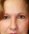blepharoplasty