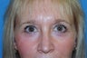 Upper and Lower Eyelid Blepharoplasty