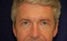 Eyelid Surgery
