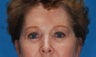 blepharoplasty with endoscopic brow lift