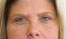 Eyelid Surgery