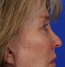 Eyelid Surgery