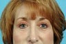 Eyelid Surgery