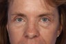 Eyelid Surgery